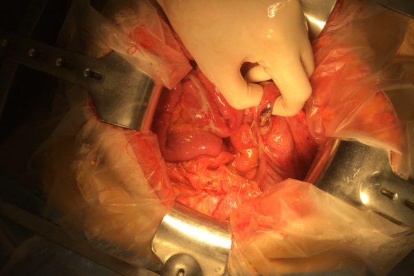 perforation de l'intestin